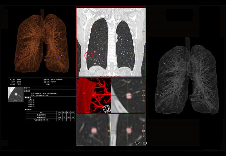 Pulmonary nodule analysis