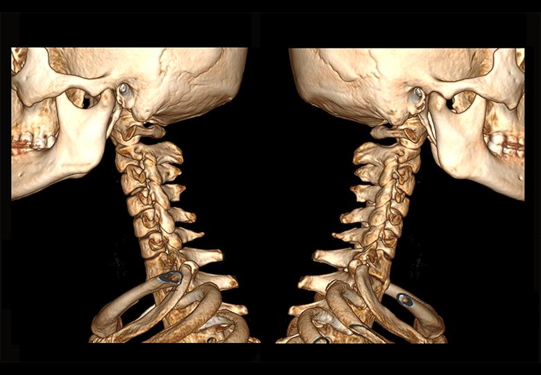Cervical vertebra VR reconstruction