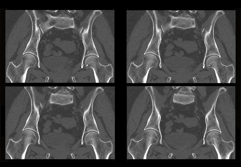 Hip joint MPR reconstruction(1.25mm)