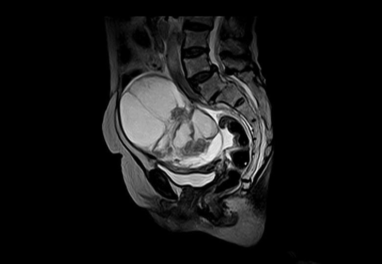 Pelvic Tumor_T2WI