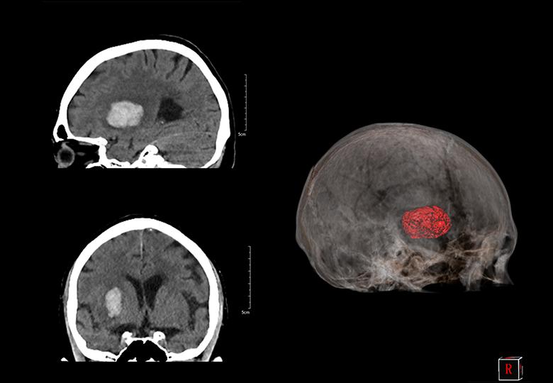  Análisis de hemorragia cerebral Perfusion