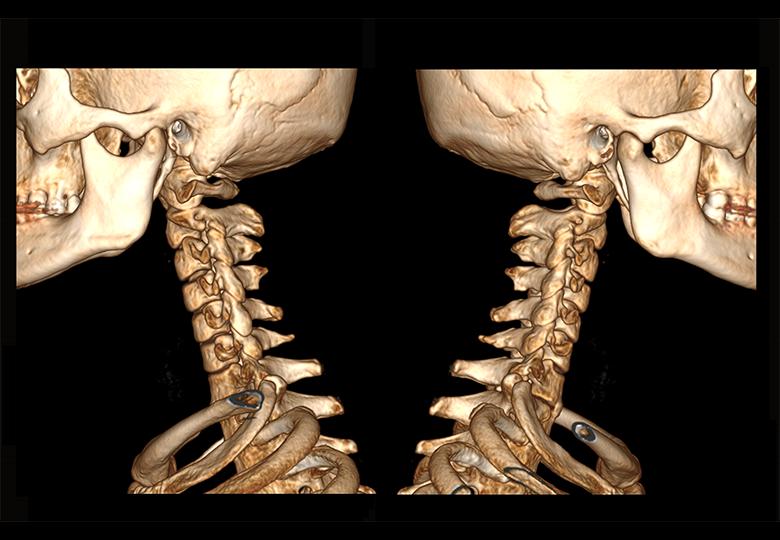  Reconstrucción VR de la vértebra cervical 