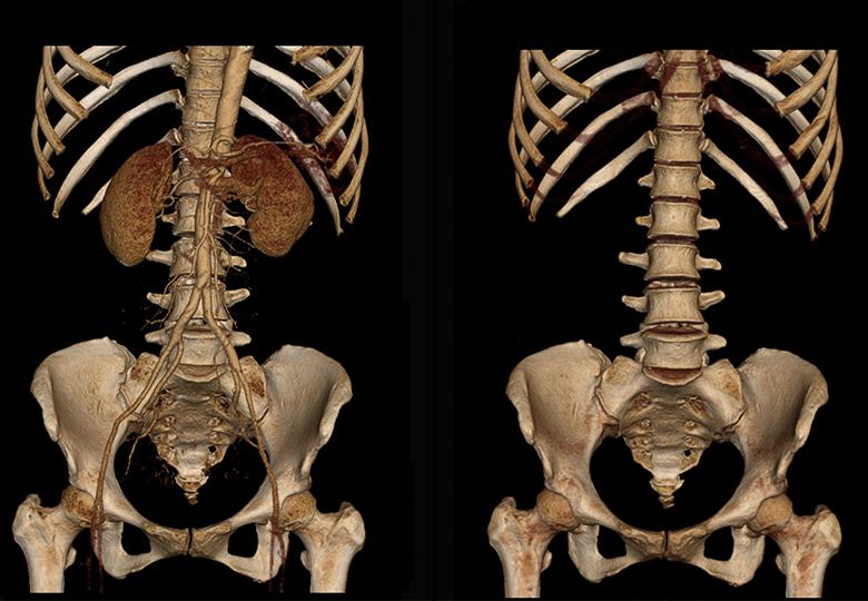  Reconstrucción VR de pelvis abdominal 