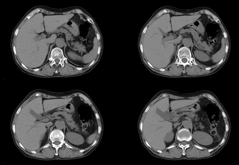  Routine_5mm_Kidney 