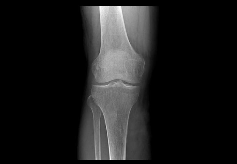 Posición orto de la articulación de la rodilla