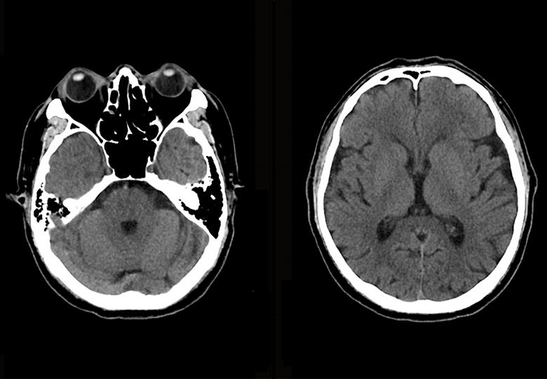 Balayage de routine (5 mm)