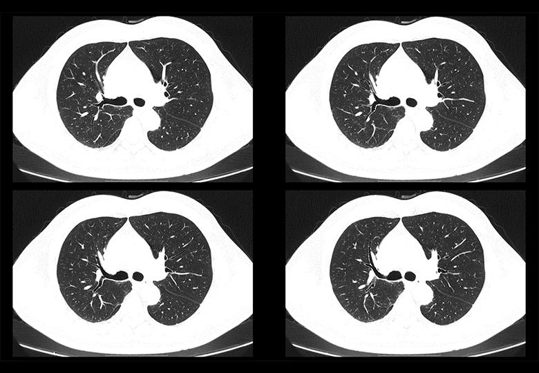 Balayage de routine (1,25 mm)