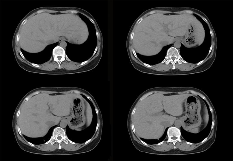 Balayage de routine (5,0 mm) -01