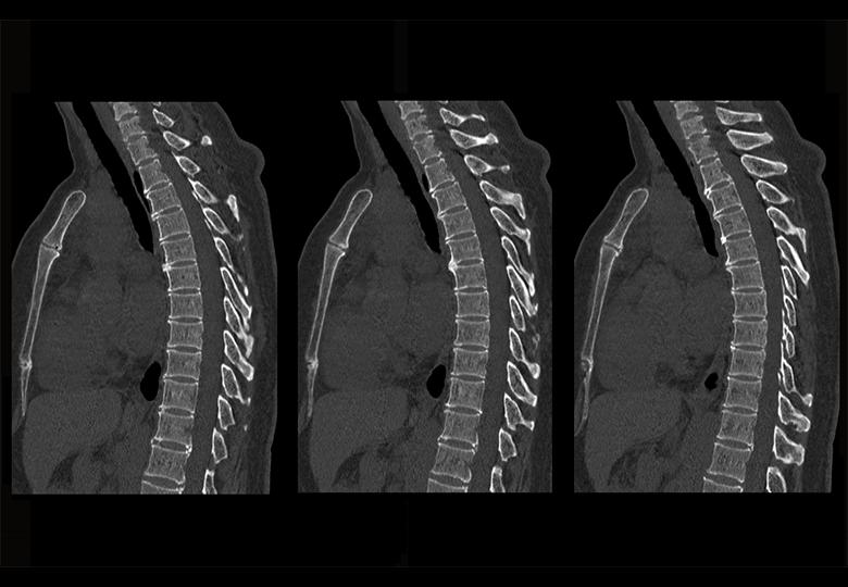 Reconstruction thoracique MPR (1,25 mm)