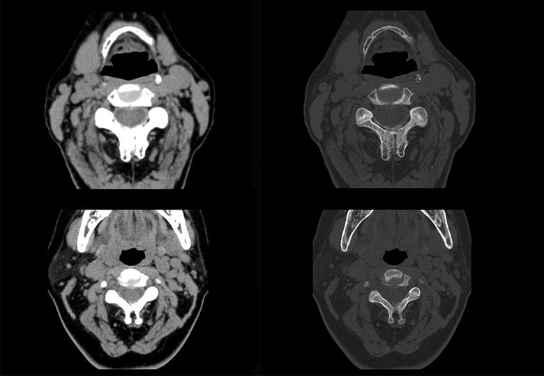 Vertèbre cervicale (1,25 mm)