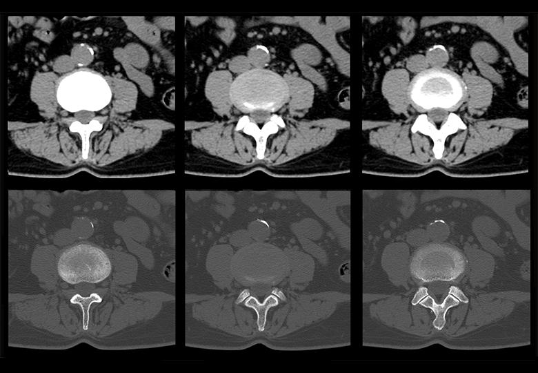 Colonne lombaire (2,50 mm) 