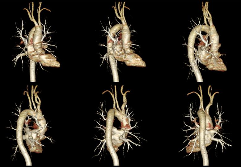 Imagerie CTA thoracique