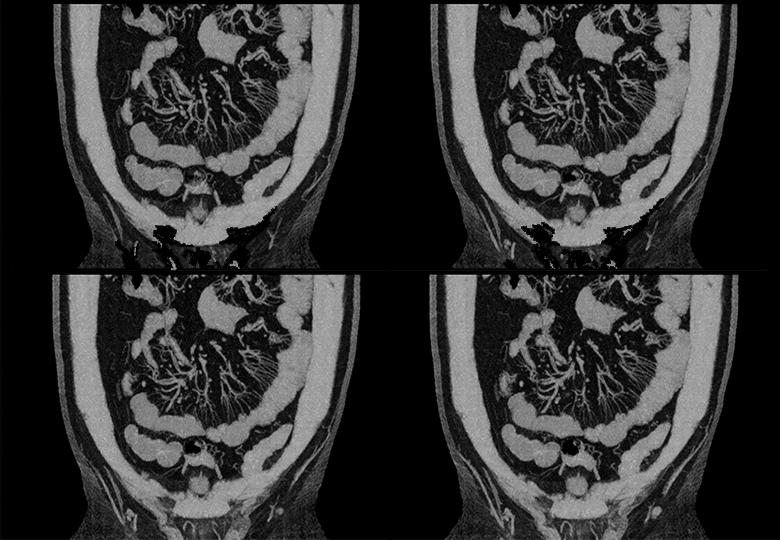 Imagerie vasculaire mésentérique