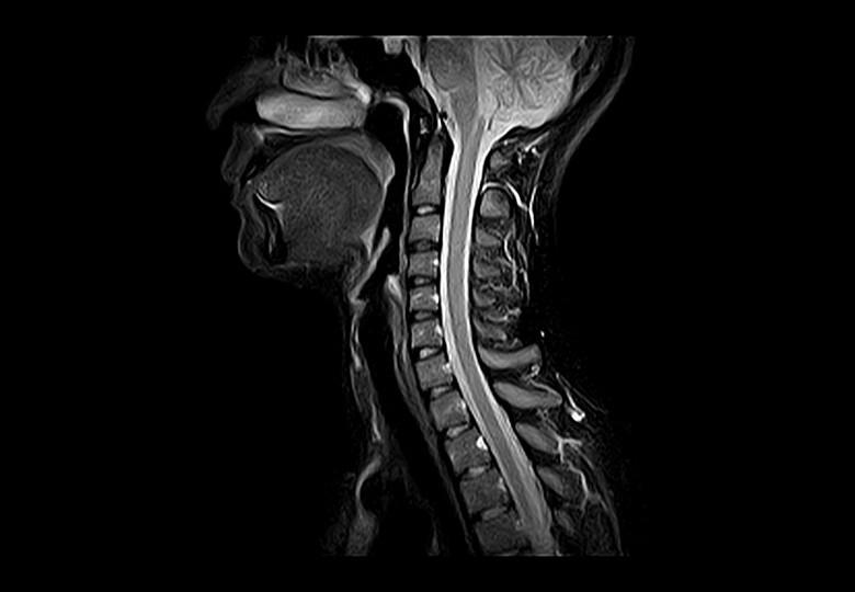 C_Spine_T2_STIR