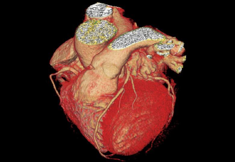 CCTA Imaging