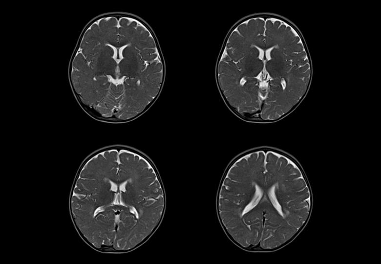 brain-pediatric, t2-fse, 21M