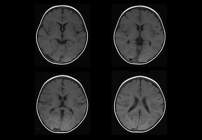 brain-pediatric, t1-fse, 21M
