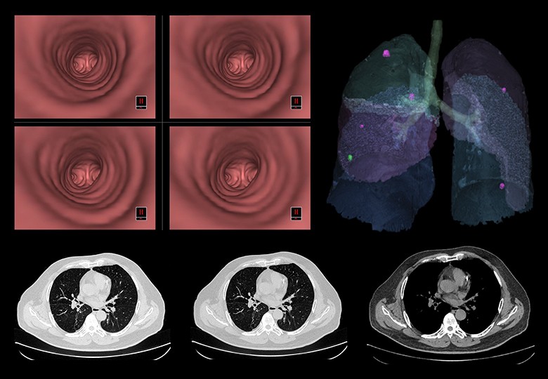 Lung Scan