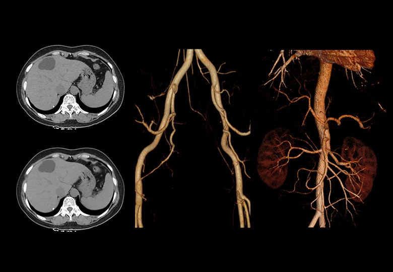 Abdomen Scan