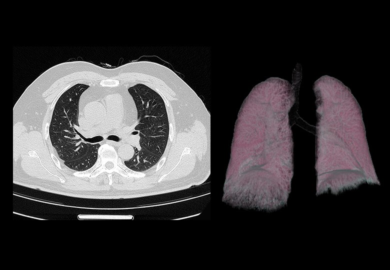 Lung Scan