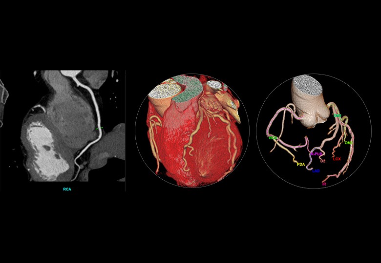 Coronary Scan