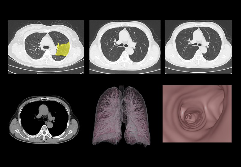 Lung Scan