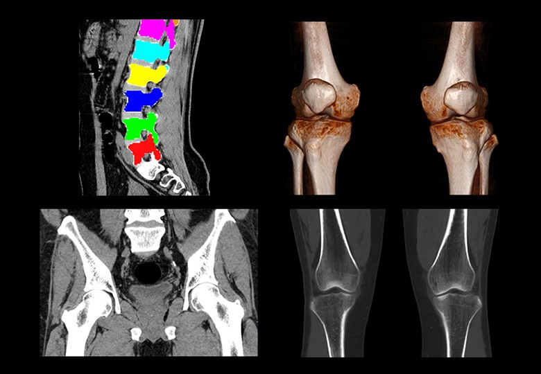 Bone Scan