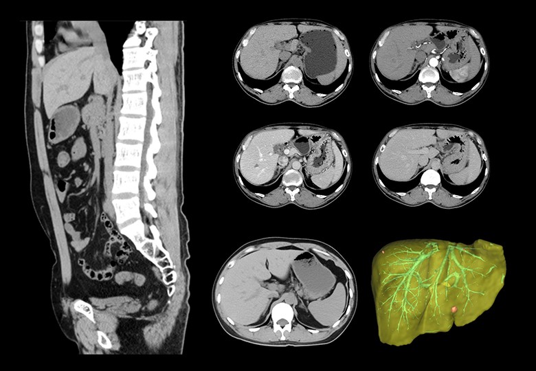 Abdomen Scan