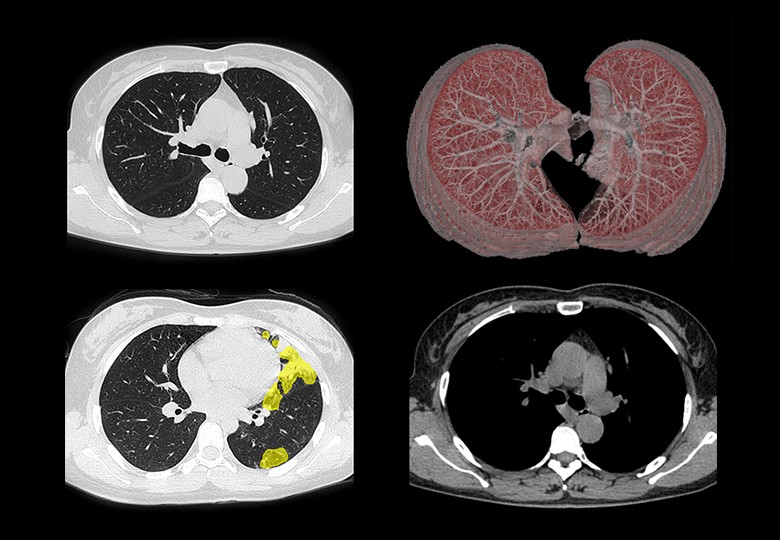 Lung Scan