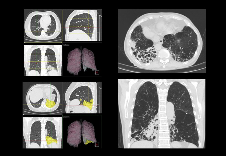 Lung Scan