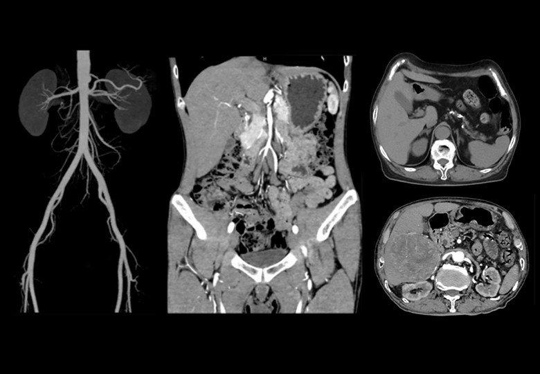 Abdomen Scan