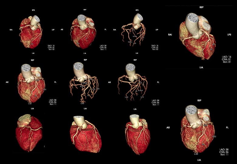 Coronary Scan