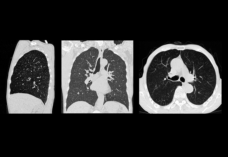 Lung Scan