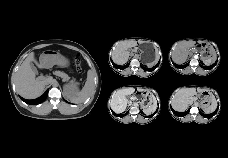 Abdomen Scan