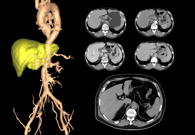 Abdomen Scan