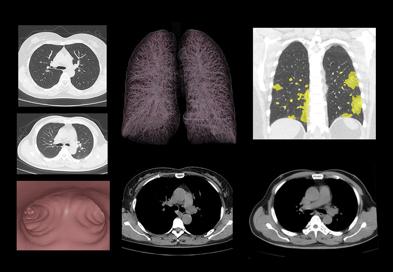 Lung Scan