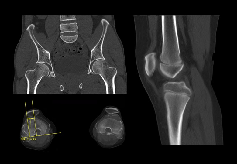 Bone Scan