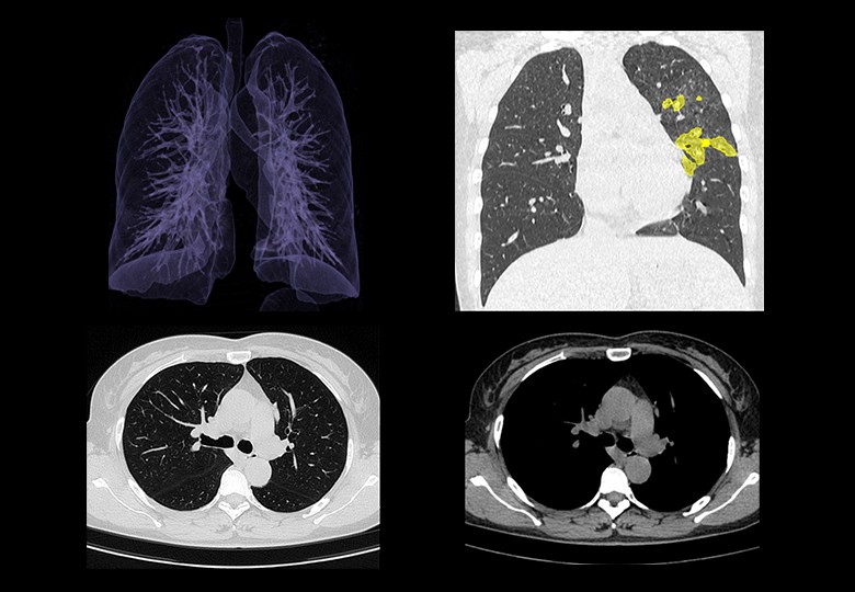 Lung Scan