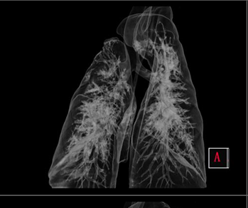 Lung Scan