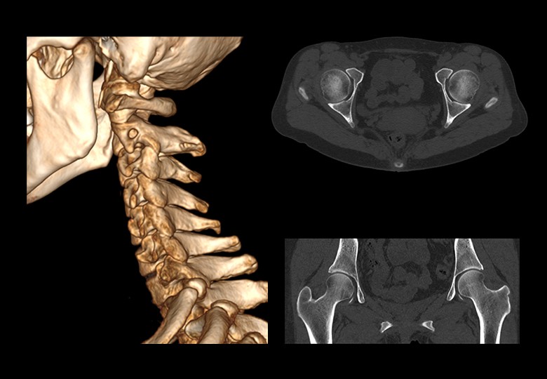 Bone Scan