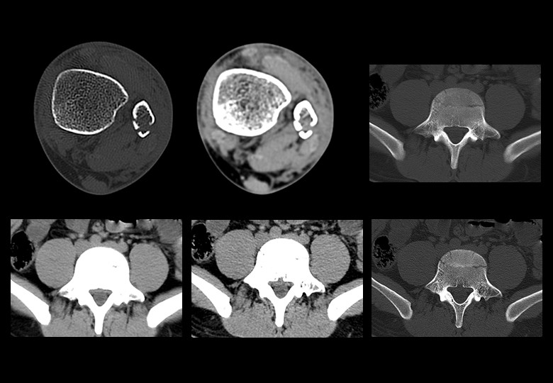 Bone Scan