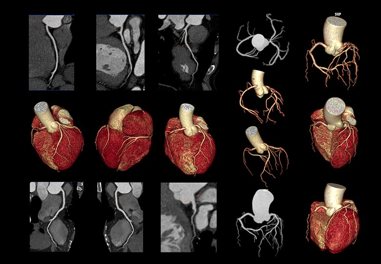 Coronary Scan