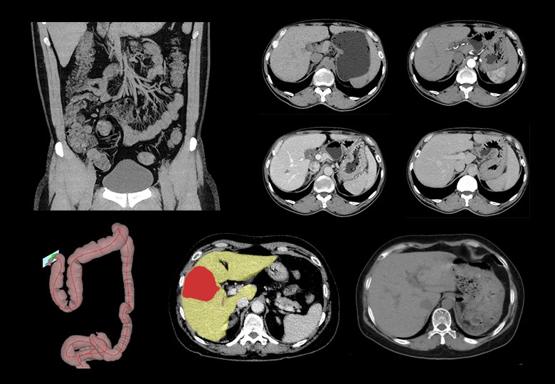 Abdomen Scan