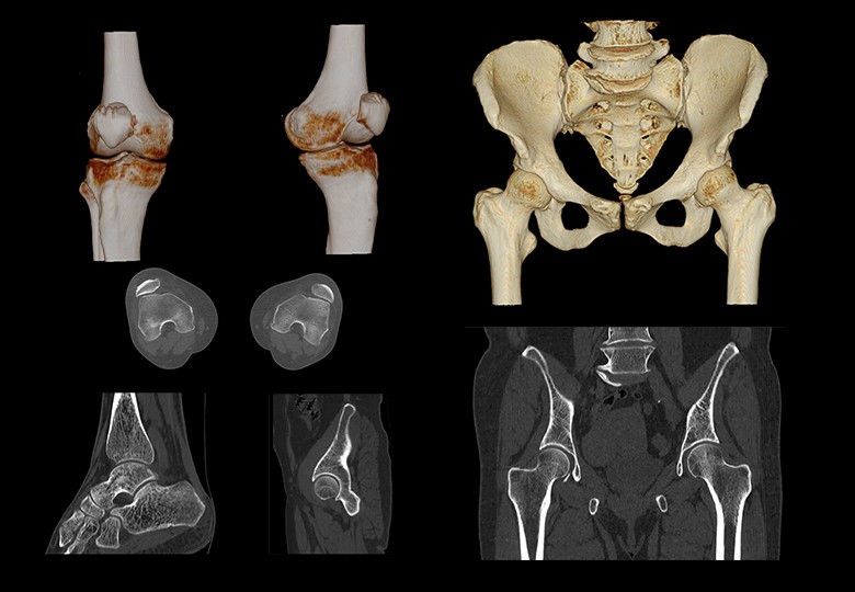 Bone Scan