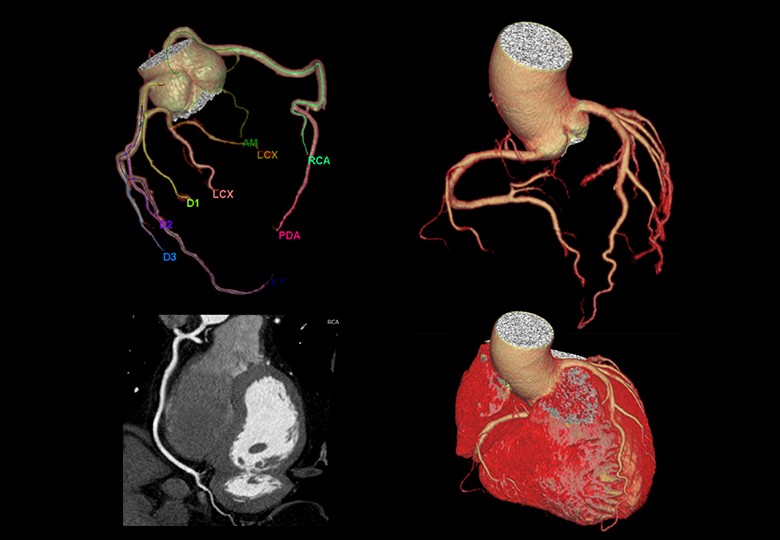 Coronary Scan