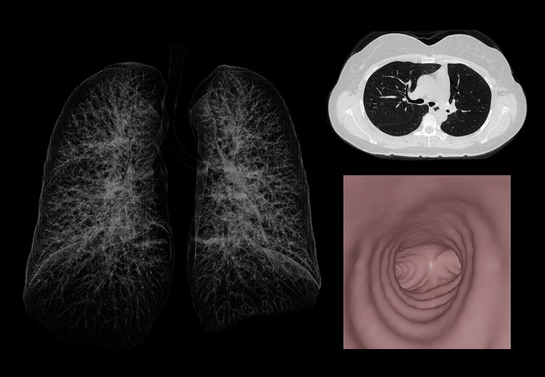 Lung Scan