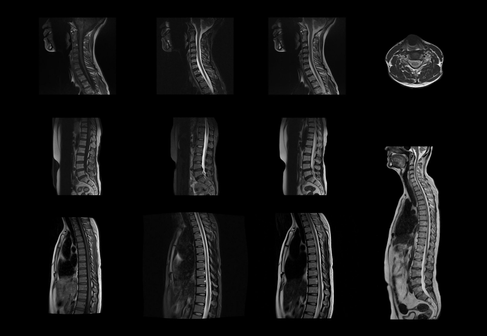 Spine Scan